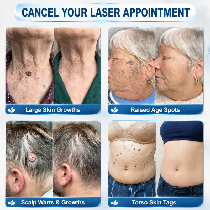 𝐑𝐚𝐥𝐚𝐝𝐲® 𝟕-𝐷𝑎𝑦 𝗧𝐚𝐠 & 𝗦𝗽𝐨𝐭 𝐄𝐫𝒂𝒔𝒆𝒓(𝐙𝐞𝐫𝐨 𝐏𝐚𝐢𝐧, 𝐙𝐞𝐫𝐨 𝐒𝐜𝐚𝒓𝒔 𝐑𝐨𝐥𝐥𝐞𝐫𝐛𝐚𝐥𝐥)💪
