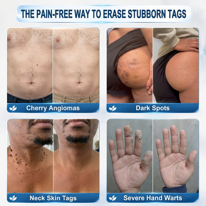 𝐑𝐚𝐥𝐚𝐝𝐲® 𝟕-𝐷𝑎𝑦 𝗧𝐚𝐠 & 𝗦𝗽𝐨𝐭 𝐄𝐫𝒂𝒔𝒆𝒓(𝐙𝐞𝐫𝐨 𝐏𝐚𝐢𝐧, 𝐙𝐞𝐫𝐨 𝐒𝐜𝐚𝒓𝒔 𝐑𝐨𝐥𝐥𝐞𝐫𝐛𝐚𝐥𝐥)💪