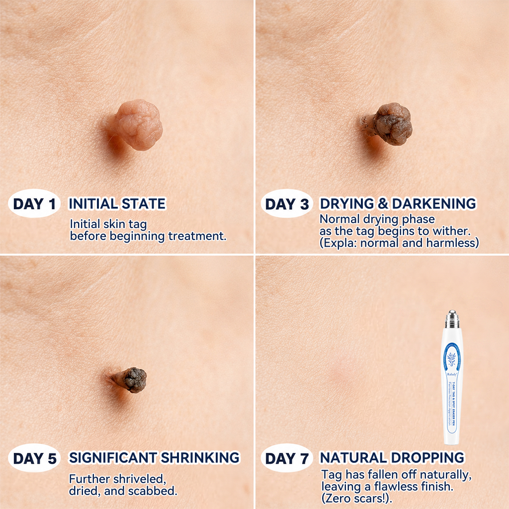 𝐑𝐚𝐥𝐚𝐝𝐲® 𝟕-𝐷𝑎𝑦 𝗧𝐚𝐠 & 𝗦𝗽𝐨𝐭 𝐄𝐫𝒂𝒔𝒆𝒓(𝐙𝐞𝐫𝐨 𝐏𝐚𝐢𝐧, 𝐙𝐞𝐫𝐨 𝐒𝐜𝐚𝒓𝒔 𝐑𝐨𝐥𝐥𝐞𝐫𝐛𝐚𝐥𝐥)💪