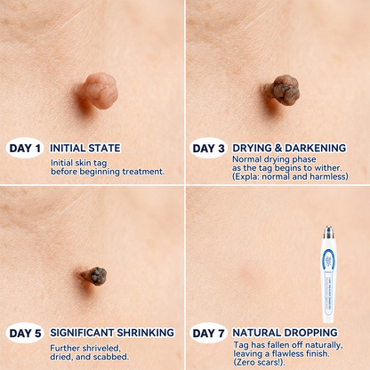 𝐑𝐚𝐥𝐚𝐝𝐲® 𝟕-𝐷𝑎𝑦 𝗧𝐚𝐠 & 𝗦𝗽𝐨𝐭 𝐄𝐫𝒂𝒔𝒆𝒓(𝐙𝐞𝐫𝐨 𝐏𝐚𝐢𝐧, 𝐙𝐞𝐫𝐨 𝐒𝐜𝐚𝒓𝒔 𝐑𝐨𝐥𝐥𝐞𝐫𝐛𝐚𝐥𝐥)💪